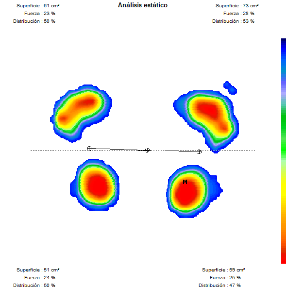 Imagen de una baropodometria (huella plantar con sensores de presión)